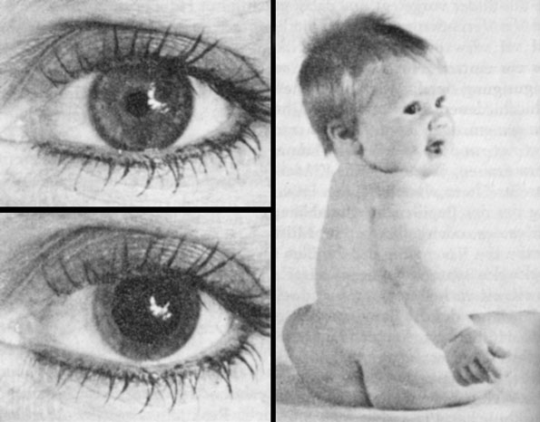 Wenn Sie das Bild eins Säuglings betrachten, wird die Größe Ihrer Pupillen sich leicht verändern. Ob sie sich erweitern oder zusammenziehen, hängt dabei von Ihrem Geschlecht ab und davon, ob Sie Kinder haben. Man hat herausgefunden, daß ein Säuglingsfoto sowohl bei alleinstehenden Frauen als auch bei verheirateten kinderlosen Frauen und bei Müttern eine Erweiterung der Pupillen hervorruft. Dagegen zeigten ledige und kinderlos verheiratete Männer eine Pupillenverkleinerung, und nur Väter reagierten mit Erweiterung (nach Hess).